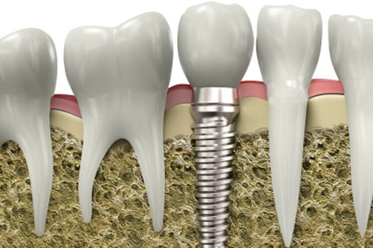 Dental implant replacing a missing tooth