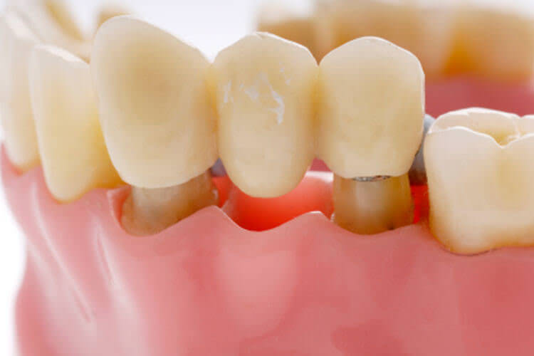 Dental bridges