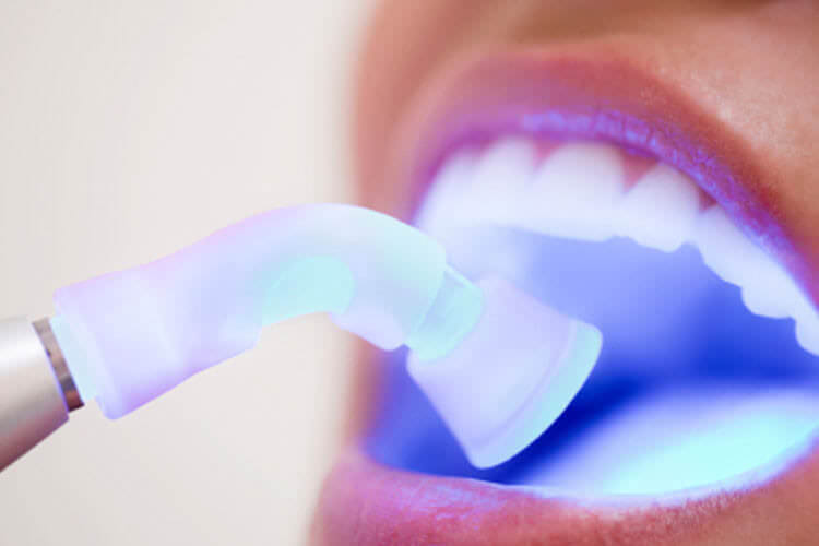 White composite fillings