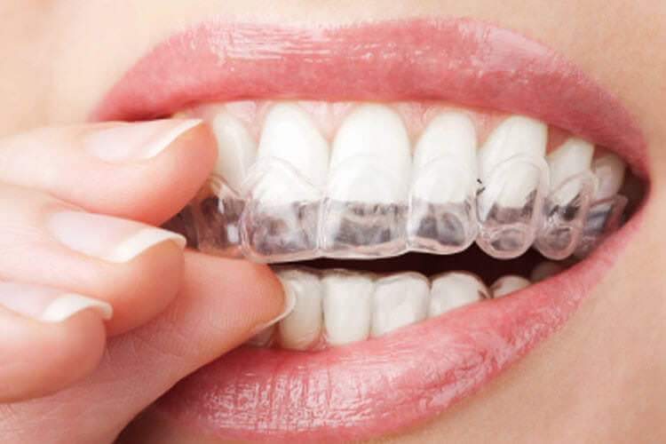 Invisalign clear aligners