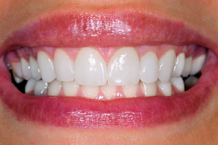 Porcelain veneers