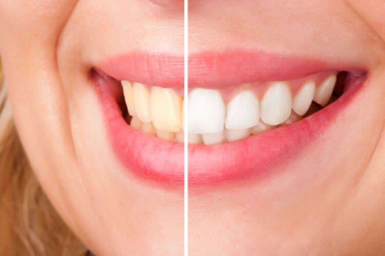 Tooth whitening
